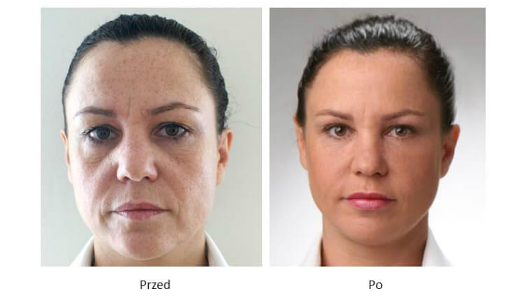 ollie-pl-korekta-bruzd-nosowo-wargowych-kinii-marionetek-powiekszenie ust-zdjecia-przed-po