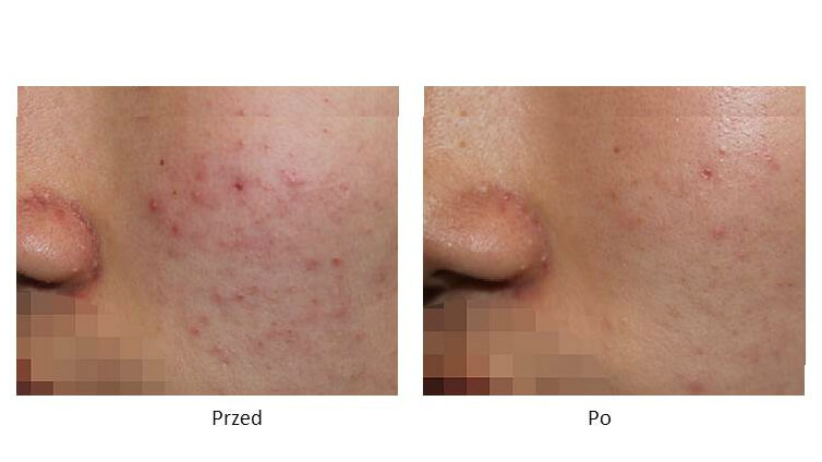 ollie-pl-szkolenie-z-laseroterapii-ipl-efekty-zabiegow-tradzik