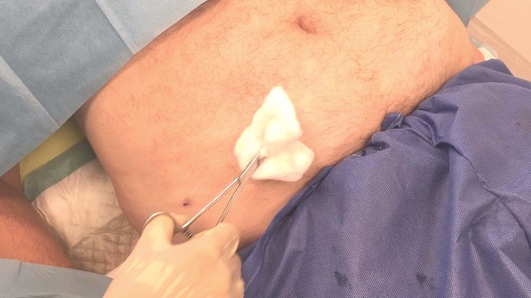 Wywiad OLLIE z dr Gabrielem Rucińskim - Zabieg Lipotransferu