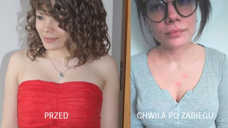 Jak pozbyć sie włókniaków - przed i po