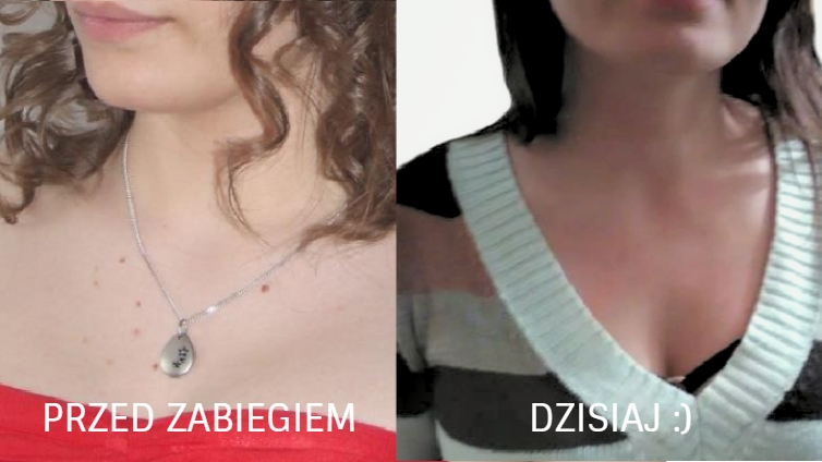 Jak pozbyc sie włókniaków - przed zabiegiem i dzisiaj